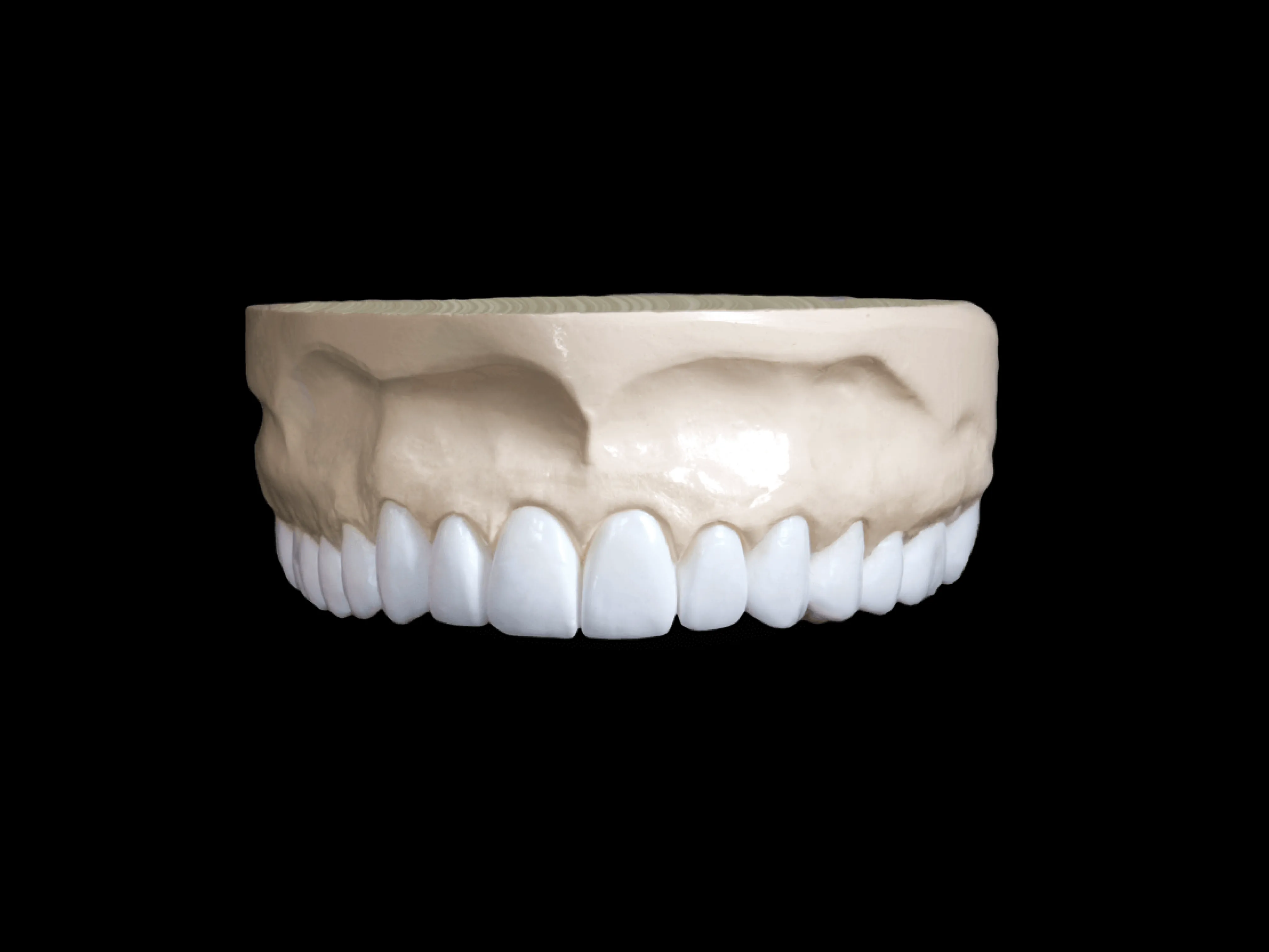 Diagnostic Wax-Ups